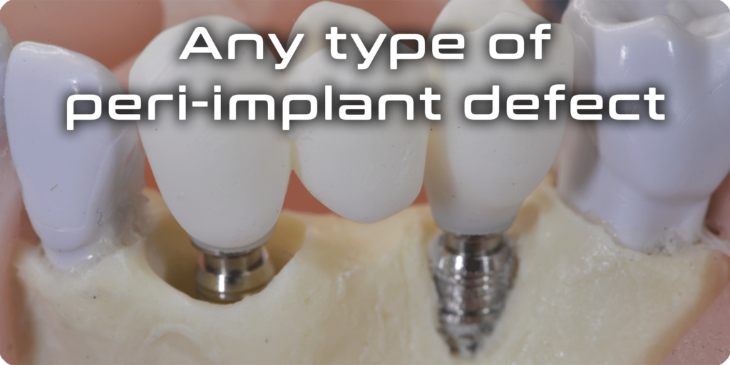 Any tipe of peri-implant defect