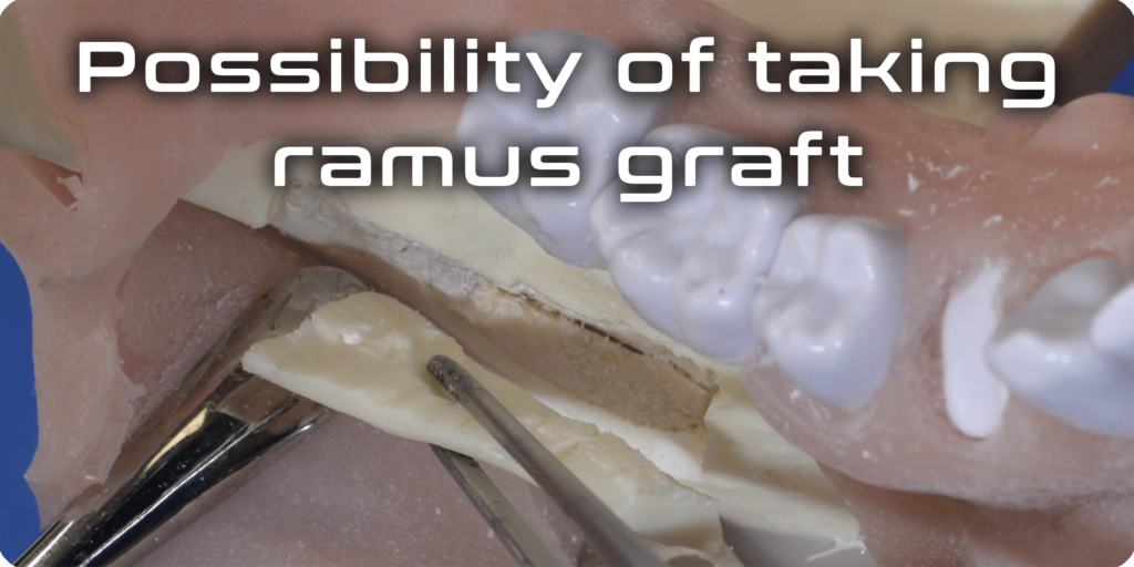 Possibility of taking ramus graft