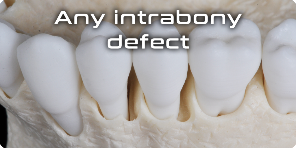 Any intrabony defect