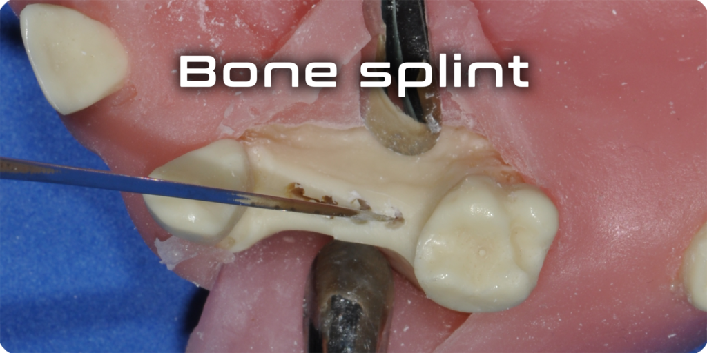 Bone splint