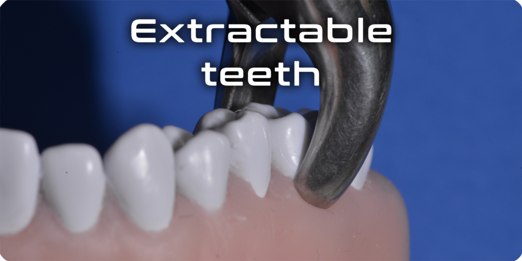 Extractable teeth