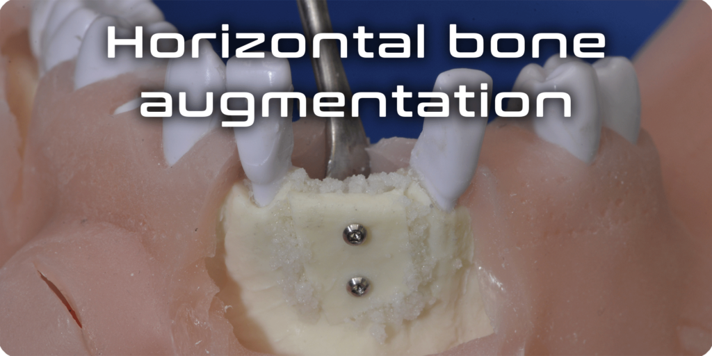 Horizontal bone augmentation