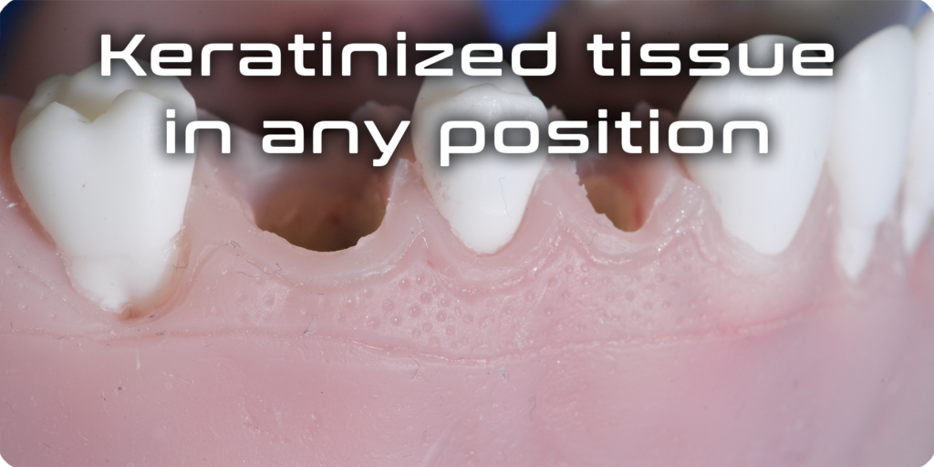Keratinized tissue in any position