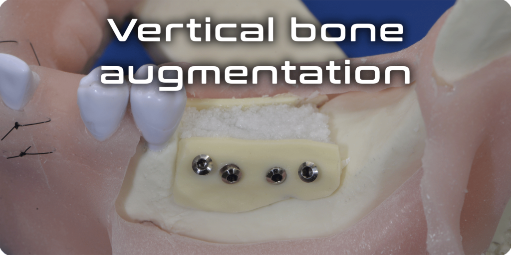 Vertical bone augmentation