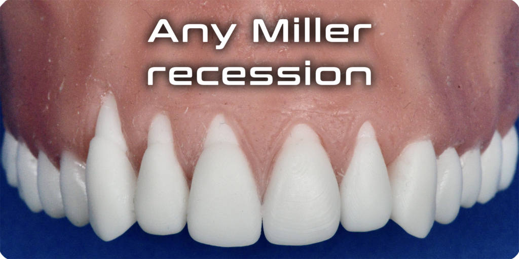 Any Miller recession